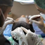 Haarpigmentierung vs. Haartransplantation